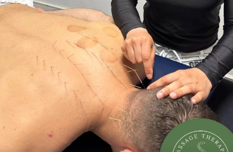 Close-up of a dry needling treatment on a client's back